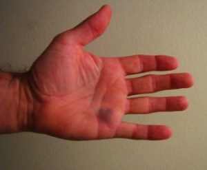BRUISED_HAND_SIDE